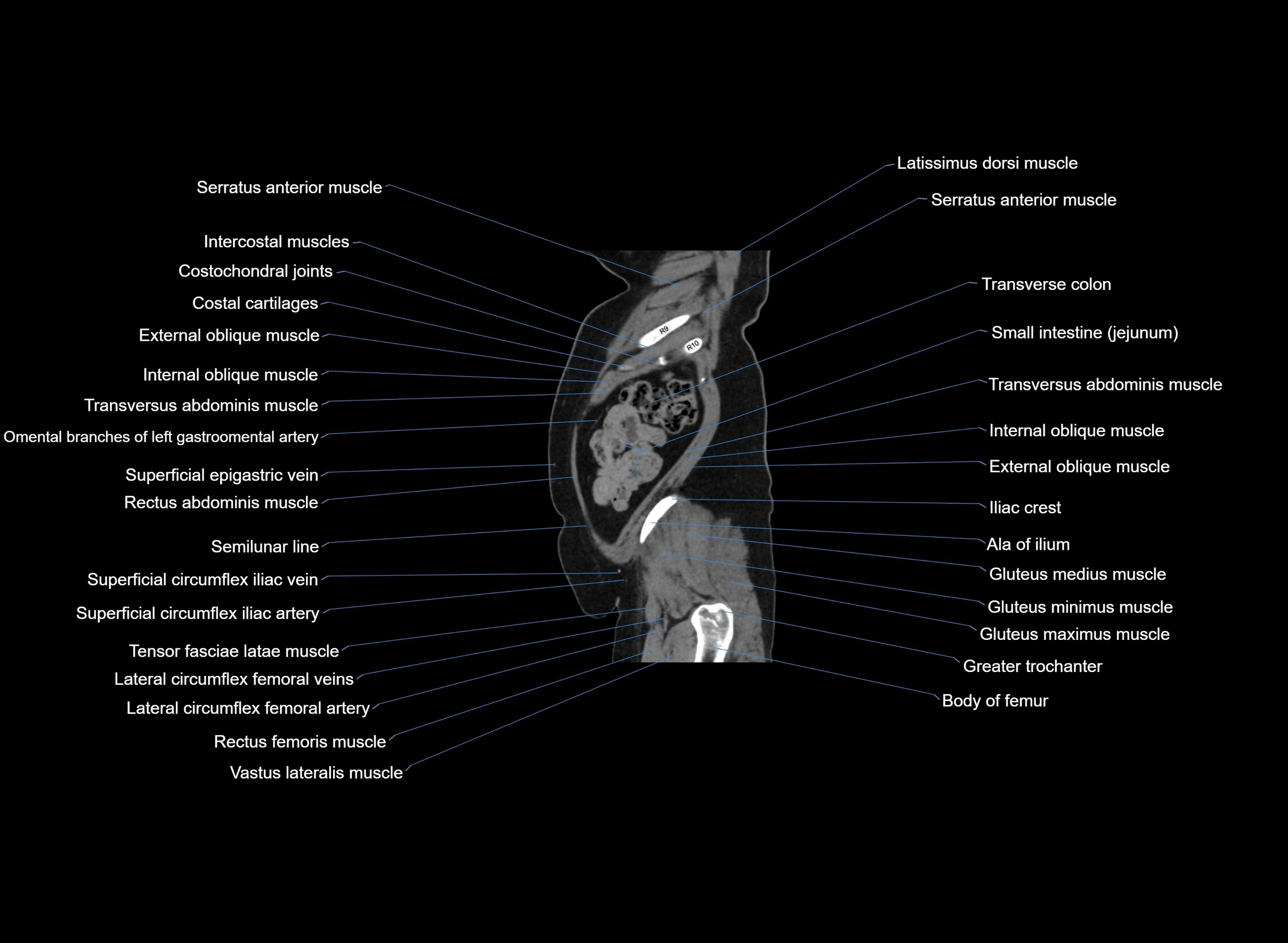 CT Abdomen sagittal cross sectional anatomy labelled radiology image -00015.webp